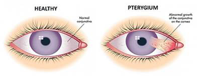 Pterygium Example